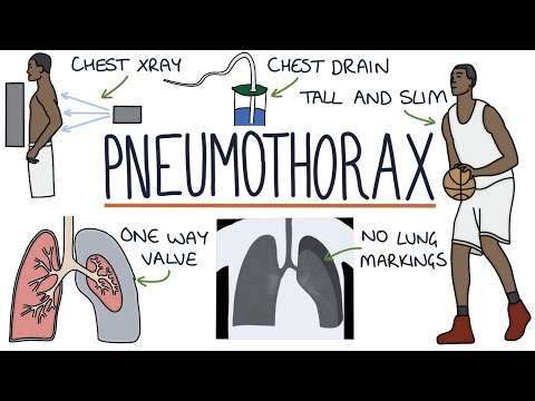 Mechanisms of Pneumothorax: A Pathophysiological Approach