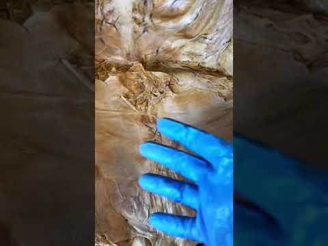 Navel Anatomy: Insights into a Unique Human Feature