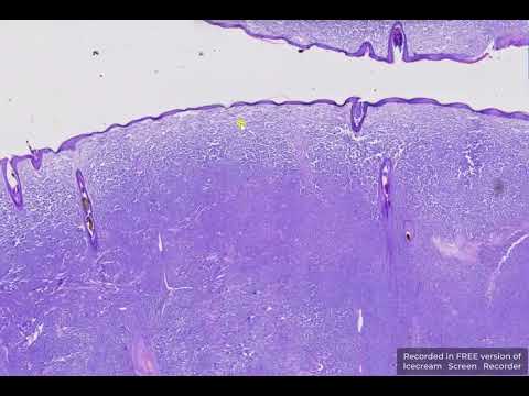 Histiocytoma Cytology and Its Role in Disease Diagnosis