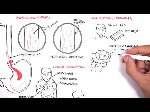 Gord Pathophysiology: Mechanisms and Implications for Health