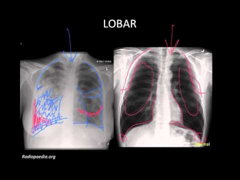 Chest X-Ray Imaging in Pneumonia Diagnosis and Treatment