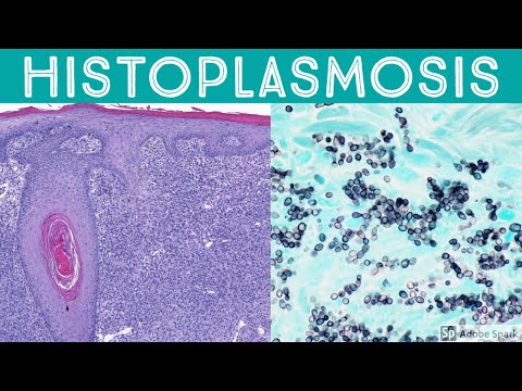 Histoplasmosis Histology: Insights into Fungal Pathology