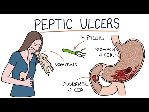 Pathophysiology of Peptic Ulcer Disease in Modern Medicine