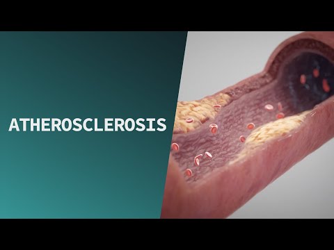 Atherosclerosis Pathophysiology: Mechanisms and Implications