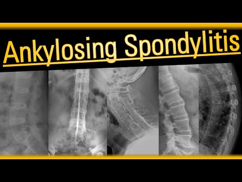 Advancements in Radiology for Ankylosing Spondylitis Diagnosis