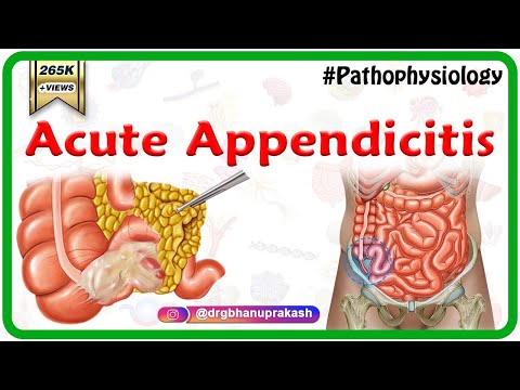 Unraveling the Pathophysiology of Appendicitis