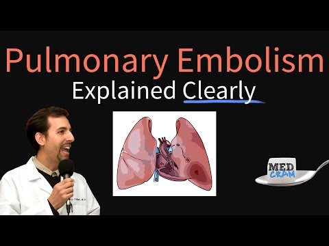 Pathophysiology of Pulmonary Embolism Uncovered Through Science