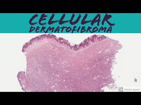 Dermatofibroma Pathology Insights for Researchers and Clinicians