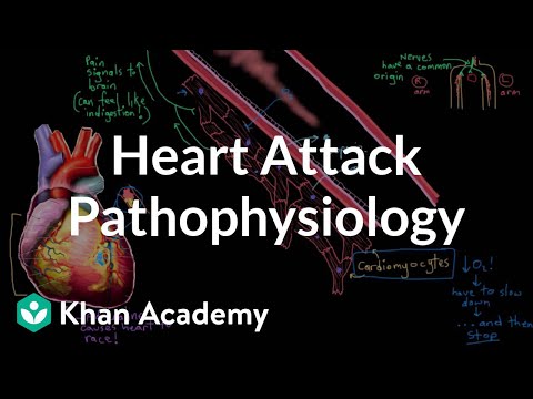 Myocardial Infarction Pathology: Mechanisms and Implications