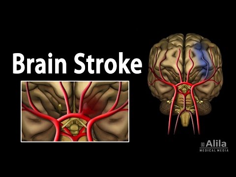 Pathophysiology of Stroke: Mechanisms and Implications for Treatment