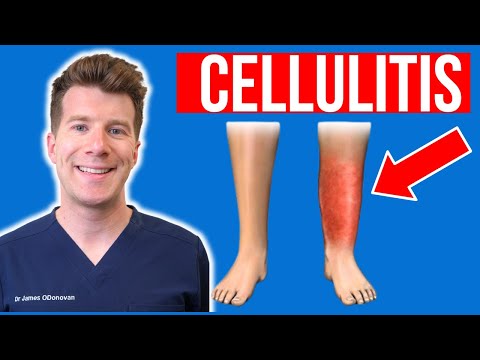 Cellulitis Pathophysiology: Unraveling Skin Infections