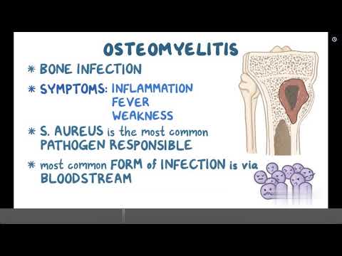 Osteomyelitis Pathophysiology: Mechanisms and Implications