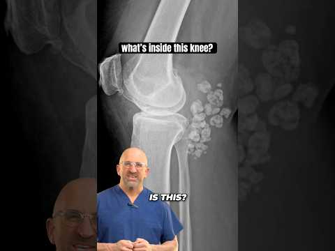 Osteochondromatosis Radiology Insights for Clinicians and Researchers