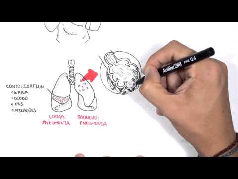 Pathophysiology of Pneumonia: Mechanisms of Infection and Inflammation