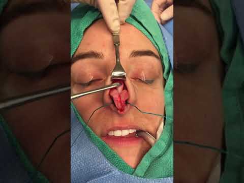 Nose Anatomy Unveiled: Structure and Function in Detail