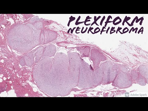 Neurofibroma Pathology Insights for Scientific Outreach