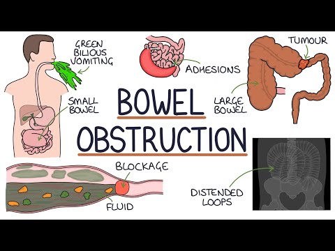 Pathophysiology of Small Bowel Obstruction in Clinical Practice