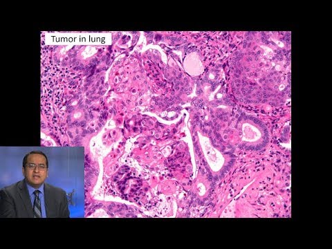 Pathology Insights into Small Cell Lung Cancer Mechanisms