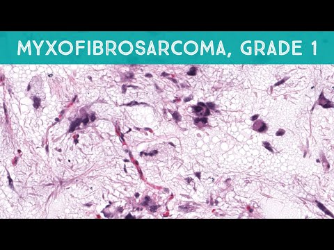 Myxofibrosarcoma Pathology: Current Insights and Advances