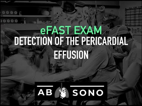 Radiological Insights into Pericardial Effusion Detection