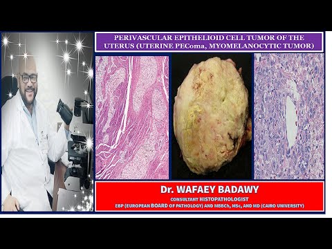 Pecoma Pathology Outlines and Their Clinical Relevance
