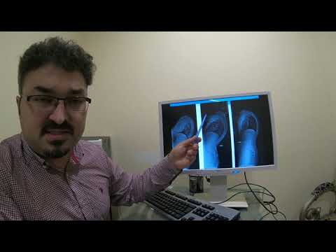Advancements in Radiology for Scheuermann's Disease Diagnosis
