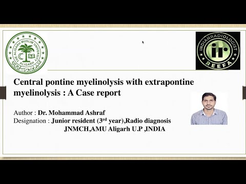 Radiological Insights into Central Pontine Myelinolysis