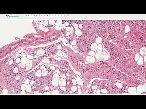 Angiolipoma Pathology Insights for Medical Research and Practice