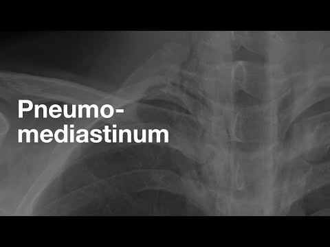 Pneumomediastinum Radiology: Advances and Clinical Significance