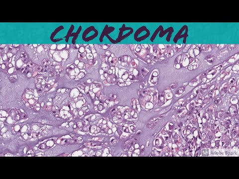 Chordoma Pathology Insights for Scientific Outreach