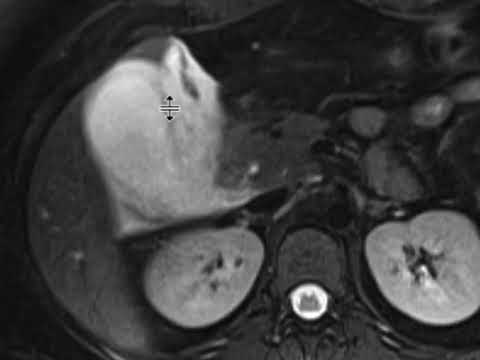 Radiology Techniques for Diagnosing Cholecystitis
