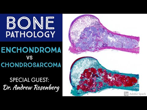 Chondrosarcoma Pathology Insights for Scientific Outreach