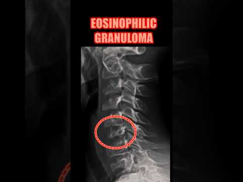 Eosinophilic Granuloma Radiology: Insights and Advances