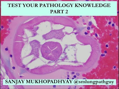 GATA3 Pathology Insights for Scientific Outreach and Education