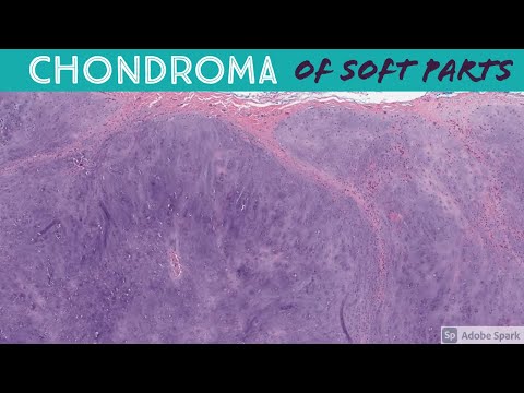 Chondroma Pathology: Insights and Research Advancements