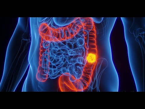CDX2 Pathology Outlines in Cancer Research and Diagnosis