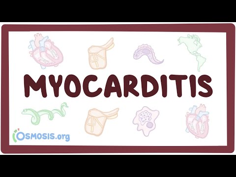 Myocarditis Pathophysiology: Mechanisms and Clinical Implications