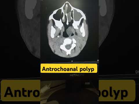 Radiological Insights into Antrochoanal Polyp Diagnosis