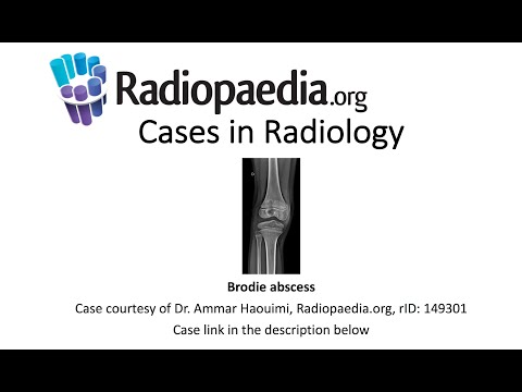 Brodie’s Abscess in Radiology: Diagnostic Approaches and Insights