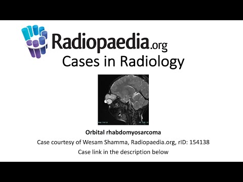 Advancements in Rhabdomyosarcoma Radiology Techniques
