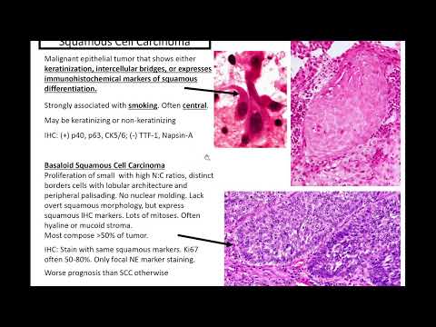CK7 Pathology Outlines in Clinical and Research Settings