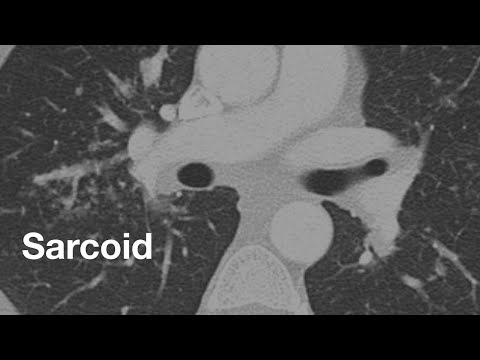 Mediastinal Lymph Nodes in Radiology: Implications for Health