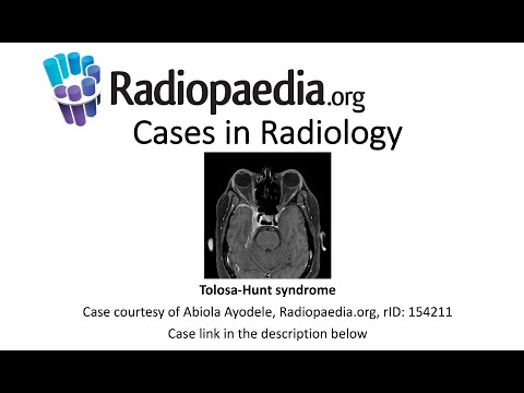 Advancements in Radiology for Tolosa Hunt Syndrome Diagnosis