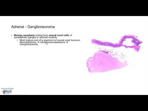 Ganglioneuroma Pathology and Its Clinical Significance
