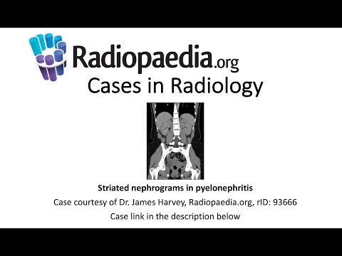 Striated Nephrograms: Insights into Renal Imaging Techniques