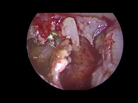 Cholesterol Granulomas in Radiology: Imaging Insights and Implications