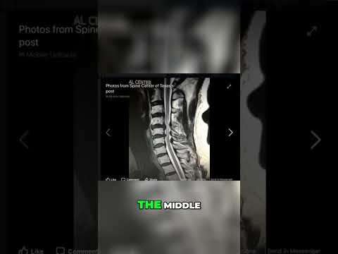 Myelomalacia in Radiology: Insights and Implications for Care