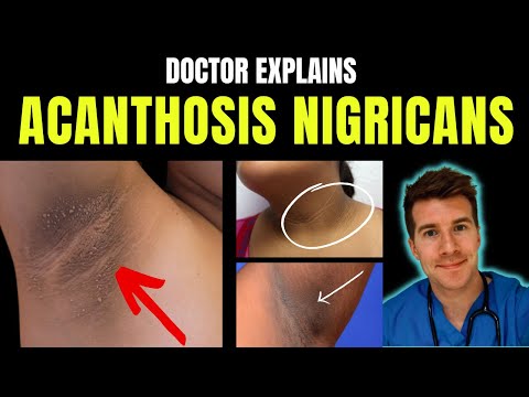 Unraveling Acanthosis Nigricans Pathophysiology in Detail