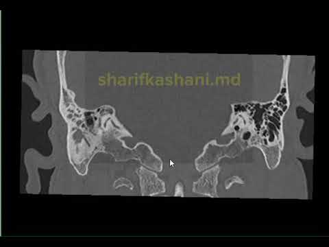 Cholesteatoma Radiology: Advancements in Diagnostic Techniques