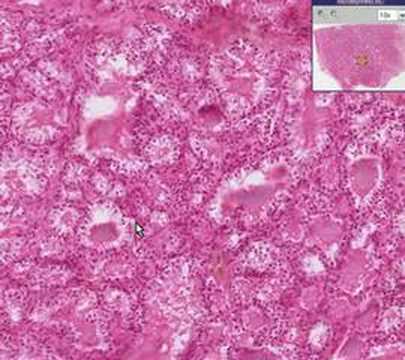 Histological Features of Graves Disease in Thyroid Tissue
